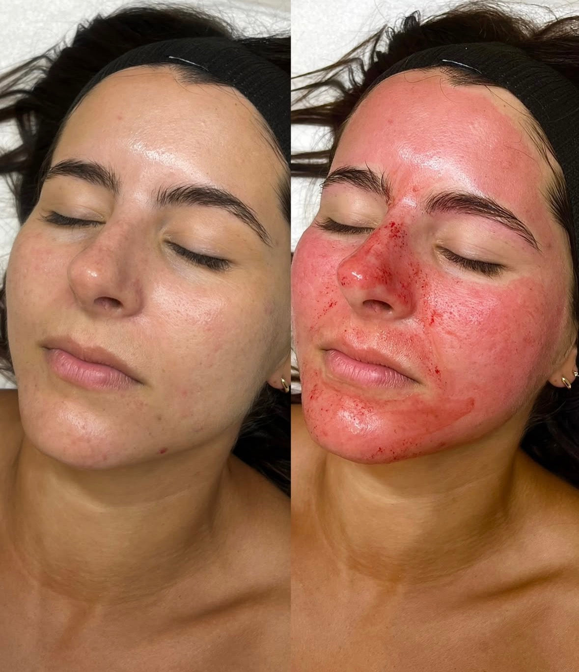 Salmon DNA Microneedling | Glass Skin Treatment in Essendon