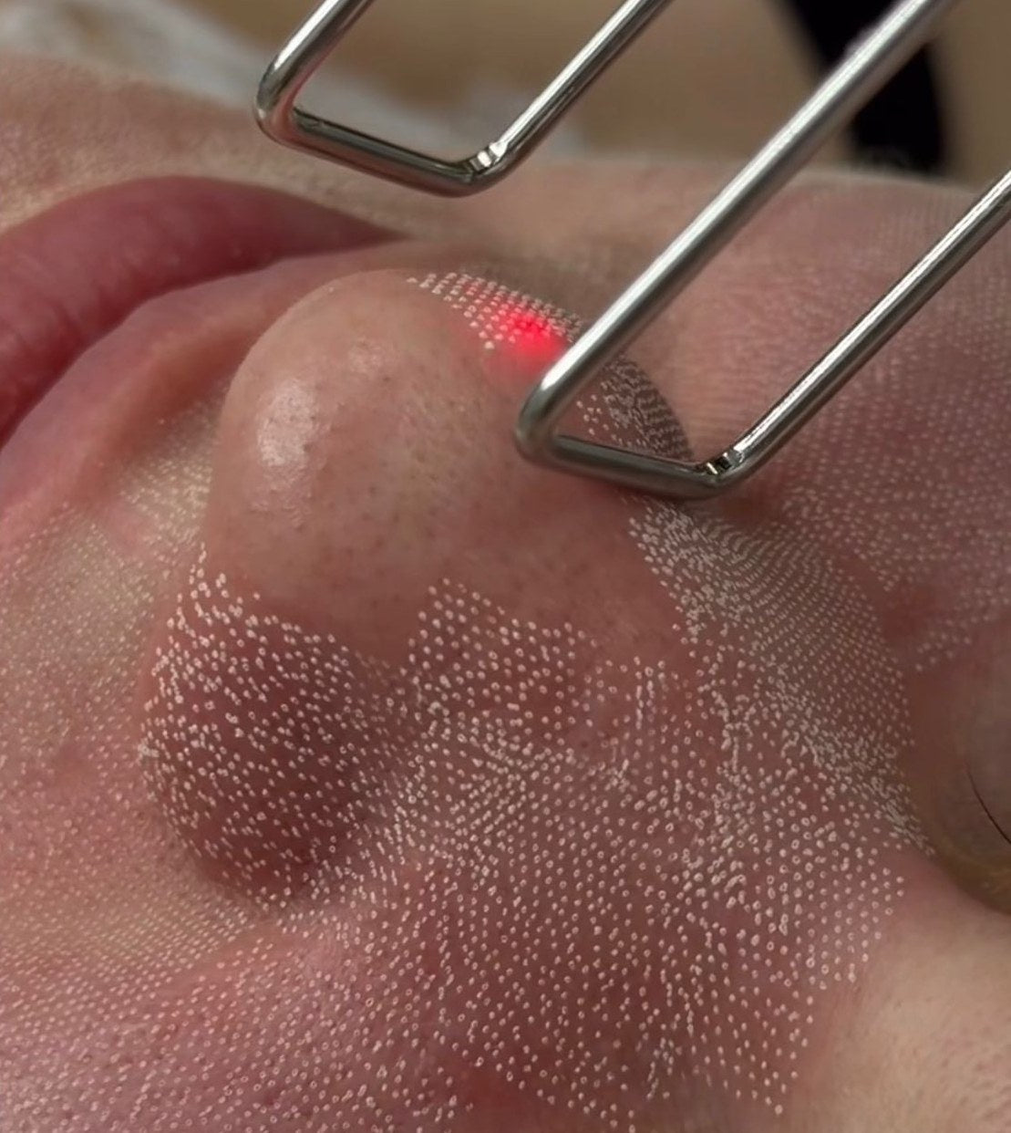Close-up of fractional CO2 laser treatment showing the microscopic treatment pattern on skin