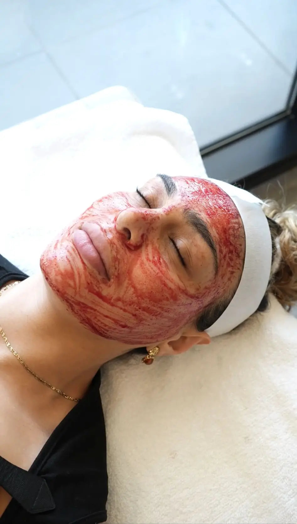 Microneedling treatment at Aura Skin Boutique, Essendon